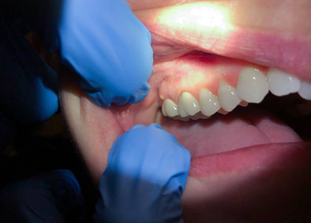 Best Knocked-Out Tooth Emergency  in Dundee, NY
